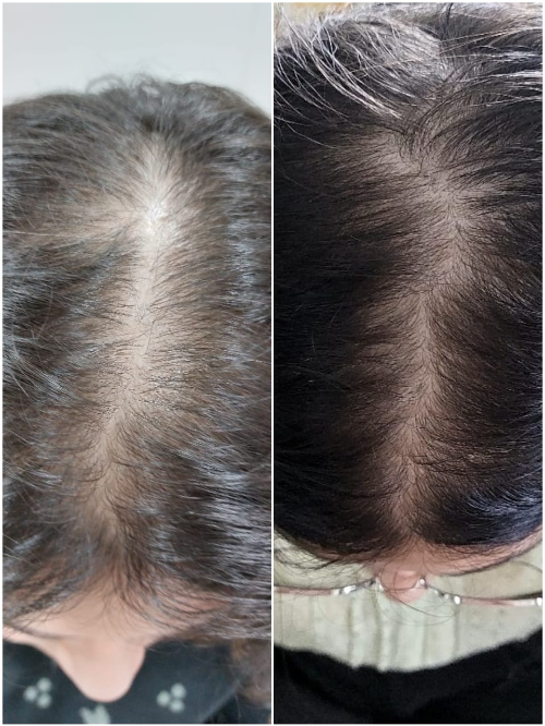 PRP Therapy for Hair
