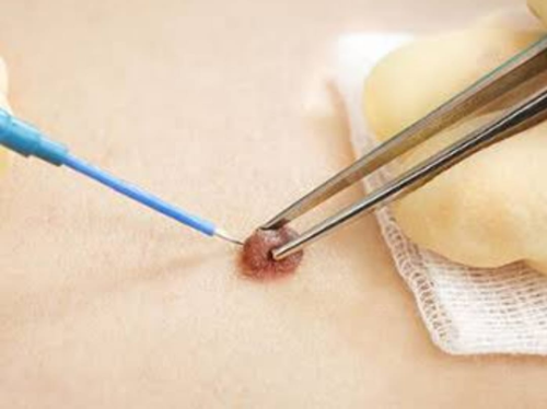 RF Cautery