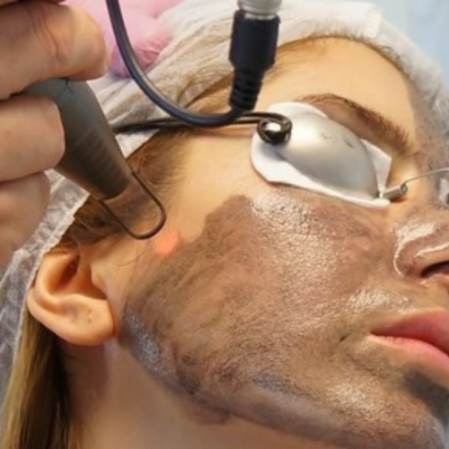 Carbon Laser Peel