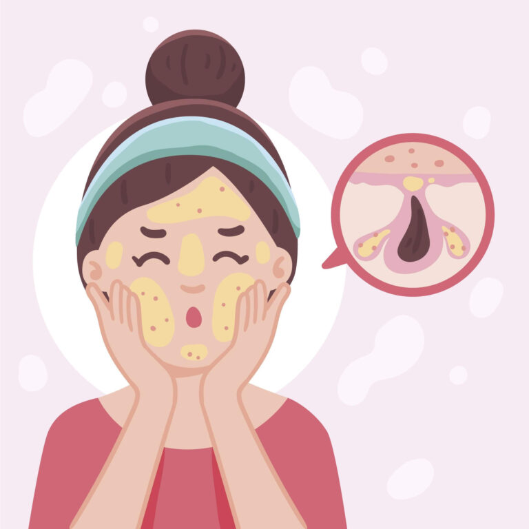 Acne And Open Pores