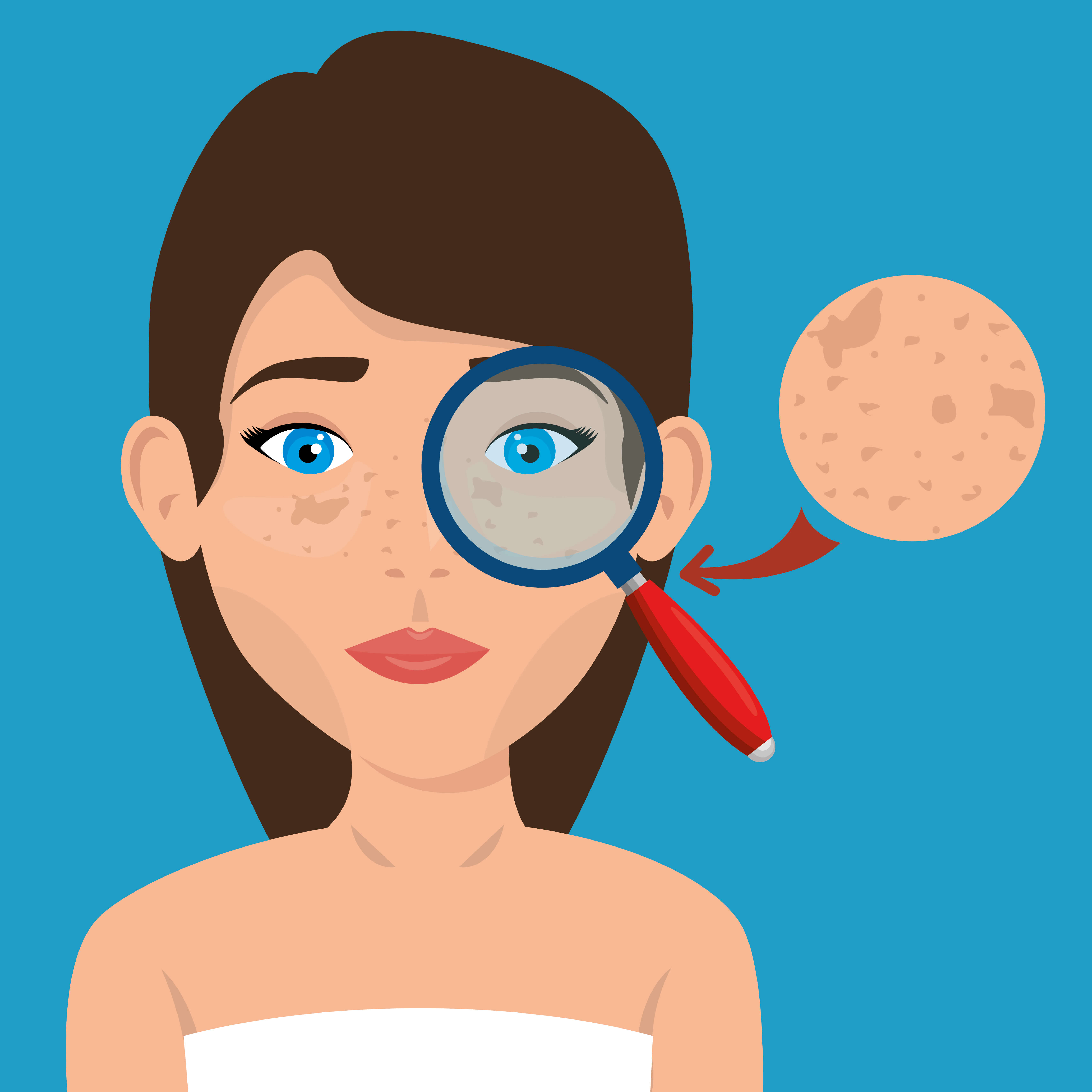 Freckles and Melasma