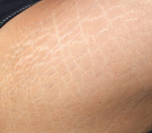Stretch Marks