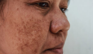 Melasma