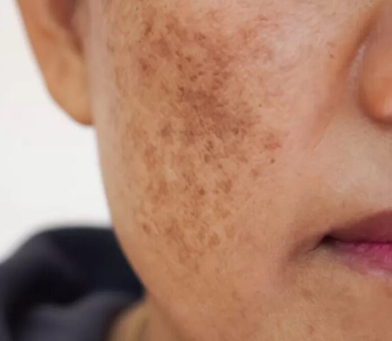 Pigmented-Lesions