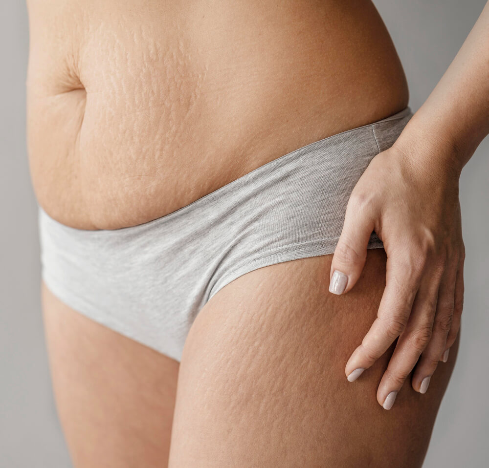 Stretch Marks