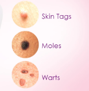 Skin tags / warts / moles